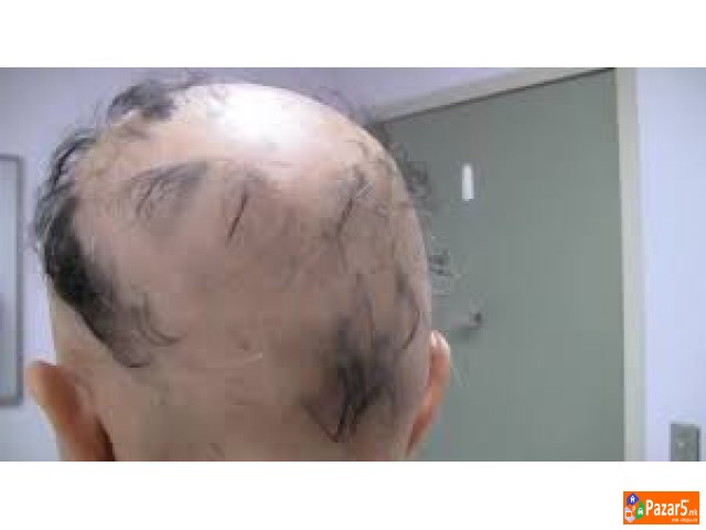 Лекување од Косопас (alopecia Areata)