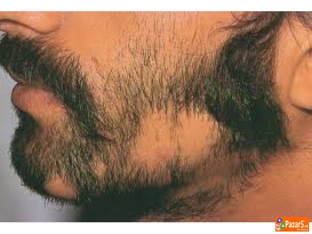 Лекување од Косопас (alopecia Areata)