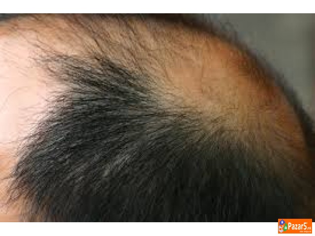 Лекување од Косопас (alopecia Areata)