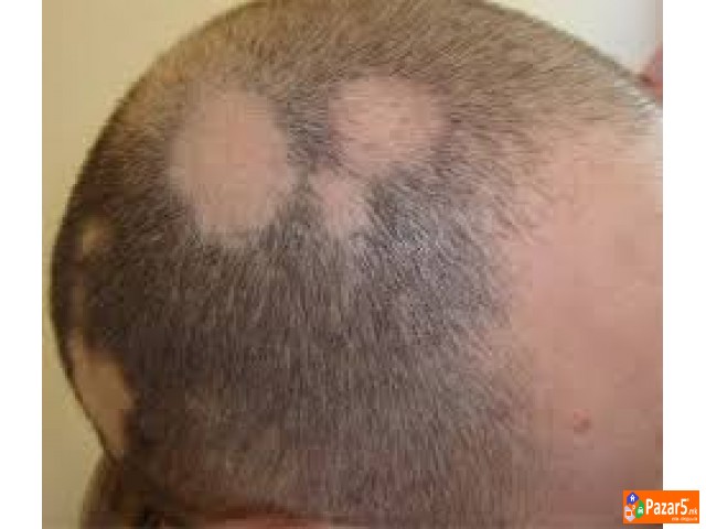 Лекување од Косопас (alopecia Areata)