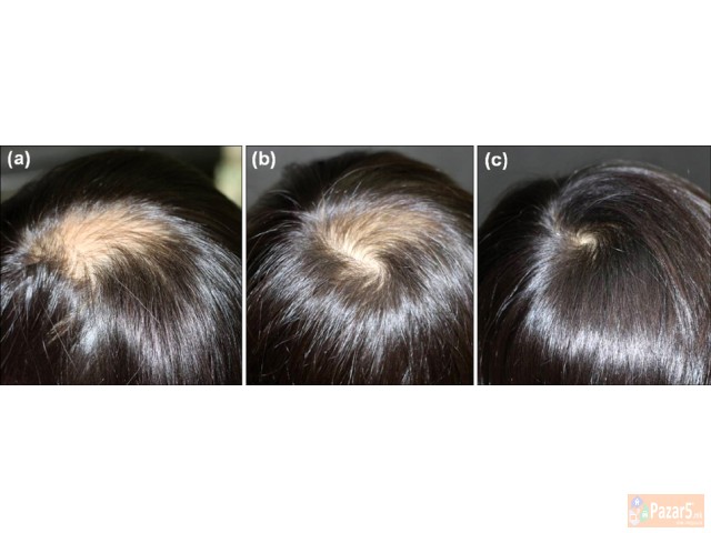 Лекување од Косопас (alopecia Areata)