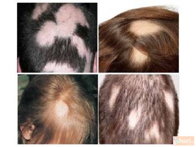 ЛЕk 100% ЕФИКАСЕН ЗА ОПАЃЊЕ НА КОСА ВО КРУГОВИ