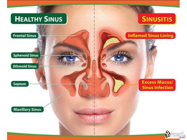 КАПКИ И МАСТ ЗА СИНУСИ и НОС